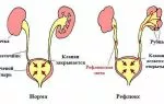 Чем характеризуется рефлюкс почки у детей?