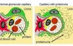 Нефротический синдром: патогенез, симптоматика, диагноз, как лечить