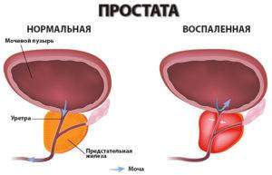 shema-vospalenija-prostaty2-300x193.jpg