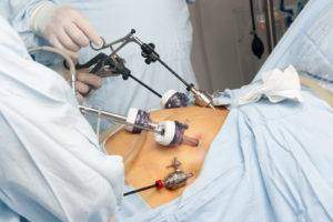 gastric-bypass-surgery-1-300x200.jpg