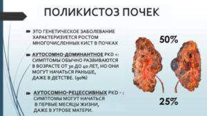 polycystic-kidney-disease-9-638-kopiya-1-300x169.jpg