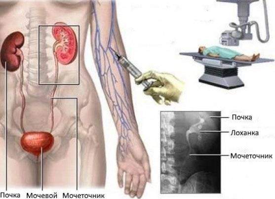 rentgen-v-diagnostike-patologii-pochek-ehkskretornaya-urografiya-i-ee-vozmozhnosti_557x403.jpg