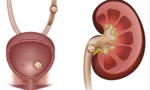 640_bigstock-Stones-In-The-Kidney-Urinary-66477544-640x383-300x180.jpg