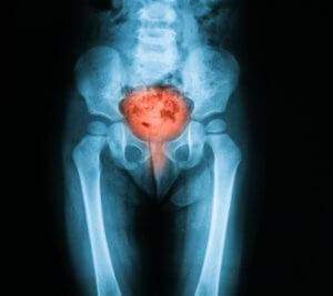 x-ray-with-bladder-highlighted-300x267-300x267.jpg