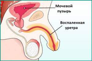 Prostatit-s-uretritom-300x200.jpg