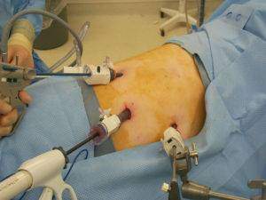 laparoscopic-adrenalectomy-during-300x225.jpg