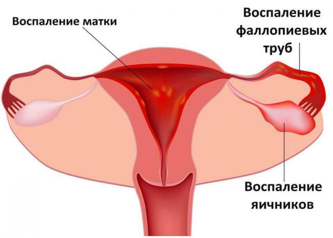 Endometrit-1.jpg