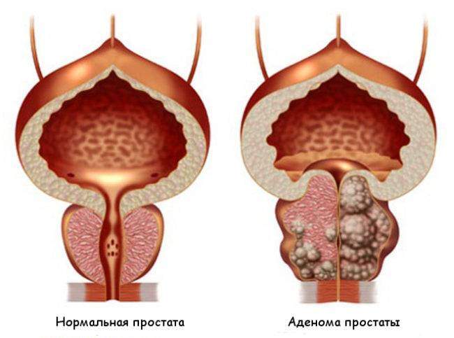 Adenoma-prostaty-u-muzhchin-e1544278435595.jpg