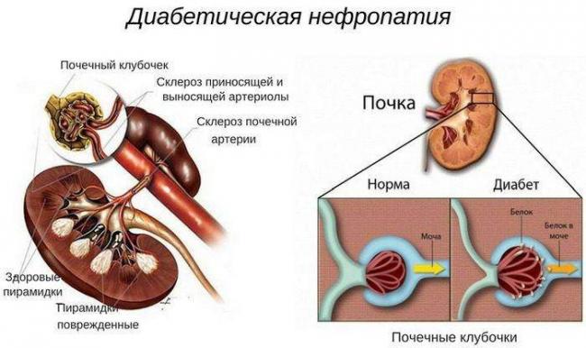 Diabeticheskaya-nefropatiya-shema.jpg