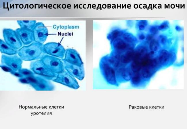 Normalnye-i-atipichnye-kletki-pri-tsitologii-osadka-mochi.-Istochnik-ppt-online.org_.png
