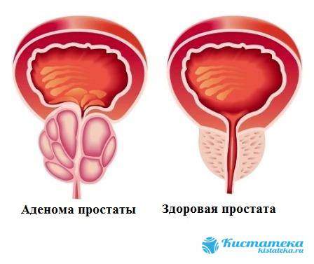 adenoma-prostaty.jpg