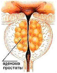 adenoma-prostaty-foto.png