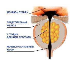 Shema-adenomy-prostaty-2-stepeni-300x240.jpg