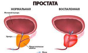 Posledstviya-prostatita-fibroz-prostaty-300x180.jpg