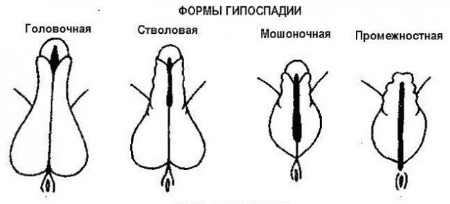 Фото гипоспадия головчатая форма