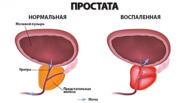 prostatit1-1.jpg