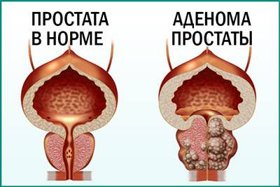 lechenie-hronicheskogo-prostatita-chesnokom_2.jpg