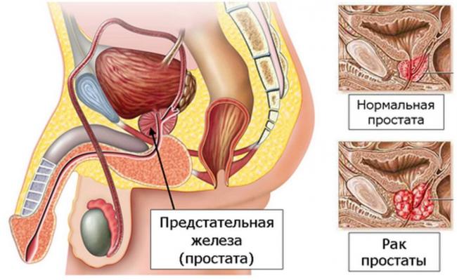 rak-prostaty-3.jpg