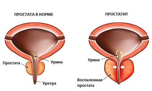 stroenie-prostaty.jpg