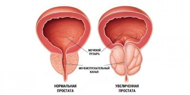kompleksnoe-lechenie-prostatita-3.jpg