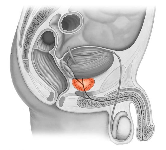 prostata-13.jpg