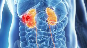 kidney-cancer-300x167.jpg