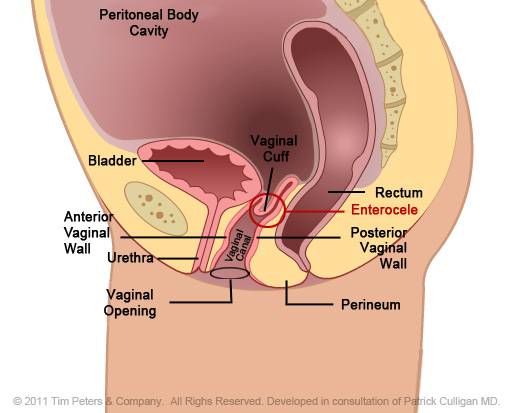 Vaginal-Vault-Prolapse-Image-2.jpg