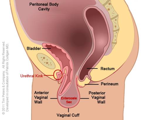 Vaginal-Vault-Prolapse-Image-4.jpg