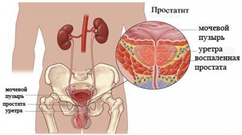 Vospalennaja-prostata-500x280.jpg